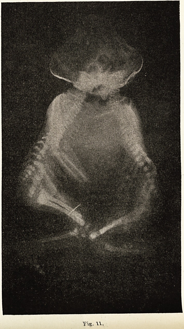 Külön személyiségek, összekapcsolt agyak: egymás szemével látnak a Hogan ikrek